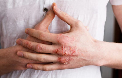 Bệnh eczema ở thường xảy ra ở bàn tay