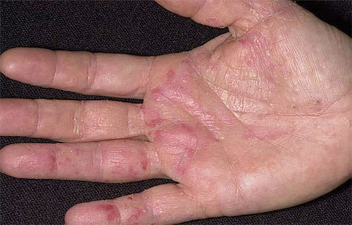 Biểu hiện của bệnh eczema là gì?