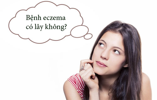 Bệnh eczema có lây không?