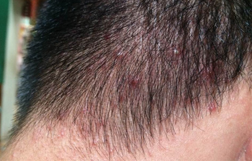 Hình ảnh của bệnh nấm da đầu
