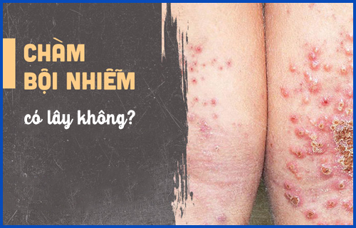 Bệnh chàm bội nhiễm có lây không?