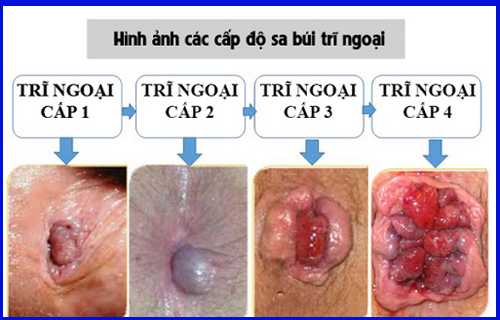 Dấu hiệu bệnh trĩ ngoại là gì?