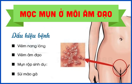 Mụn mọc ở môi âm đạo là dấu hiệu của bệnh gì?