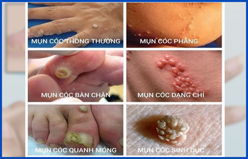 Mụn cóc dạng sợi mảnh Nguyên nhân đặc điểm và cách xử lý