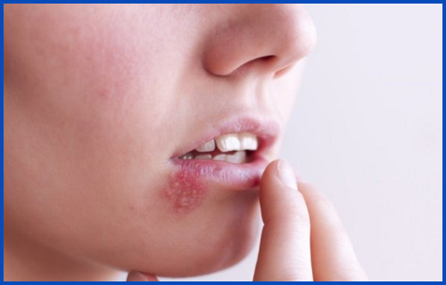 Bệnh giời leo ở miệng, cách điều trị hiệu quả nhất