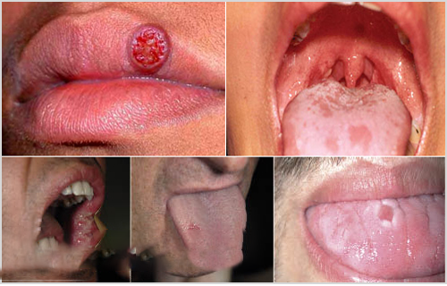 Hình ảnh bệnh giang mai ở miệng