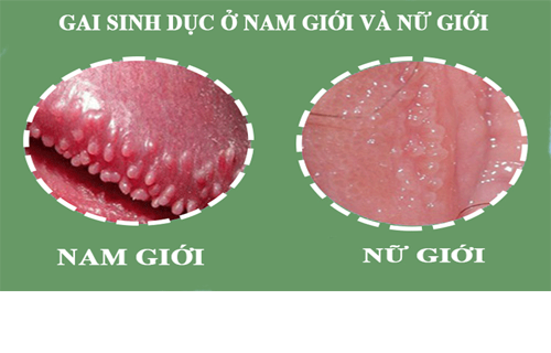 Bệnh gai sinh dục là gì?