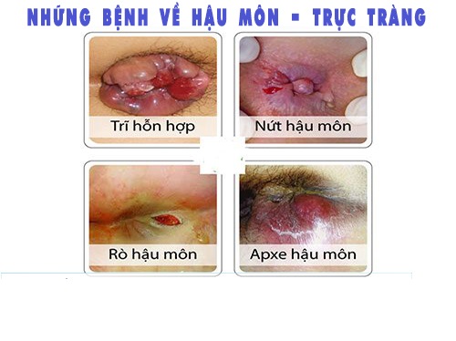 Dấu hiệu nhận biết các bệnh về hậu môn thường gặp